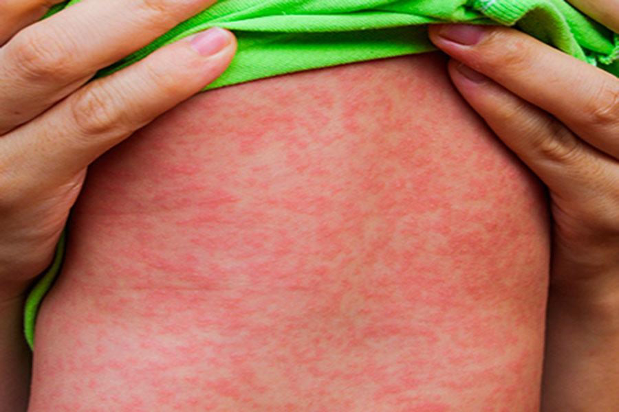 Com sintomas parecidos, dengue e sarampo não devem ser confundidos